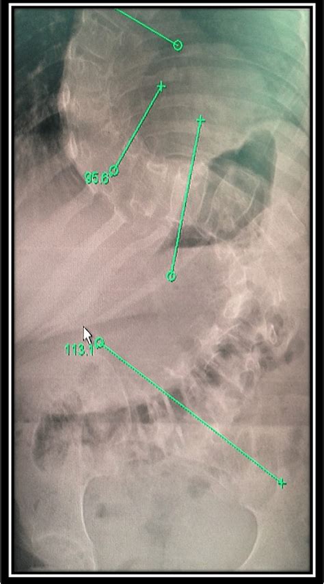 Cureus Scoliosis Corrective Surgery With Continuous Intraoperative