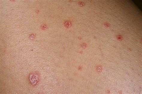 Signs And Symptoms Of Psoriasis Pictures Symptoms And Pictures