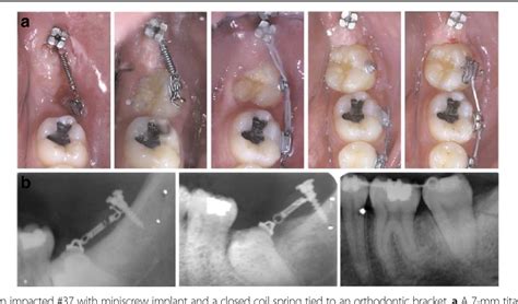 Mandibular Molar Uprighting Using Orthodontic Miniscrew Implants A