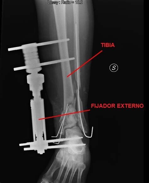 Fractura De La Tibia Tratamiento Cirugía Y Tiempo De Recuperacion