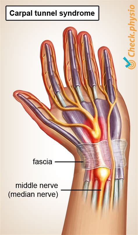 Carpal Tunnel Syndrome Physio Check