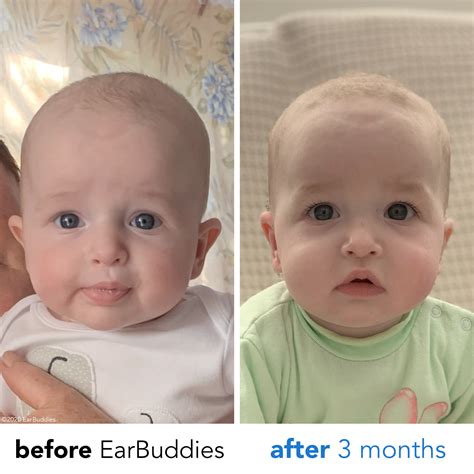 Before And Afters Earbuddies Permanent Solution To Stick Out Ears