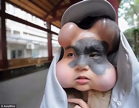 Girl With Giant Facial Mole Has Egg Like Devices Implanted Daily Mail
