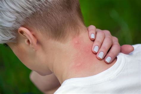Fly Bites Types Symptoms And Treatment