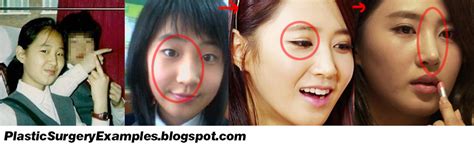 Plastic Surgery Examples Girls Generation Snsd Yuri Plastic Surgery Before And After 少女時代 소녀시대 유리