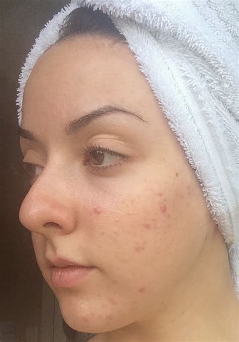 My Skins Journey Week 3 Banish Acne Scars