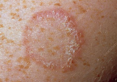 Ringworm On Arm Stock Image M2700050 Science Photo Library