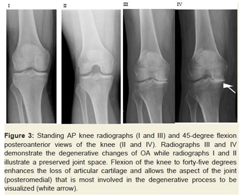 Knee X Ray의 Anatomy와 Positioning 네이버 블로그