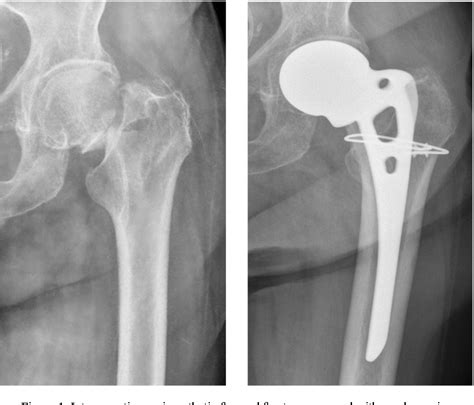 Figure 1 From Intraoperative Periprosthetic Fractures Around Austin