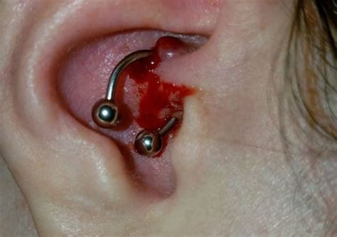 Daith Piercing Pain Scale Cost Infection Pictures Bump Cleaning