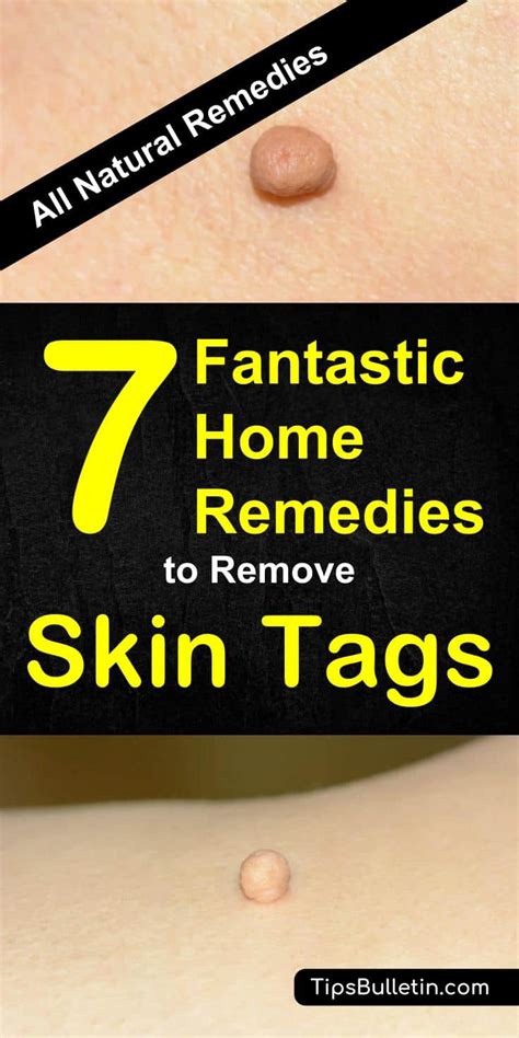 7 fantastic home remedies to remove skin tags