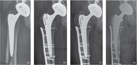 Periprosthetic Fractures Of The Proximal Femur Beyond The Vancouver