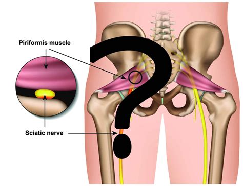 Piriformis Of Pelvic Outlet Syndrome Fysiolearning