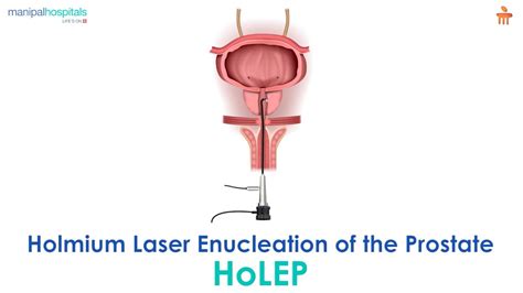 What Is Holmium Laser Enucleation Of The Prostate L Manipal Hospitals Bengaluru Youtube