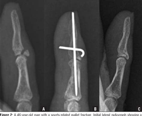 Mallet Fracture X Ray Mallet Finger Litfl Trauma Library A Hand