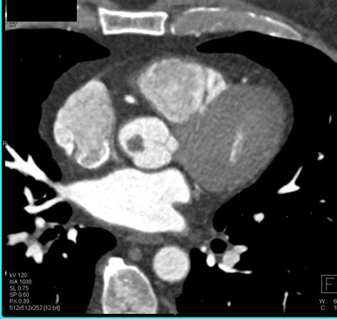 Papillary Fibroelastoma On The Aortic Valve Cardiac Case Studies