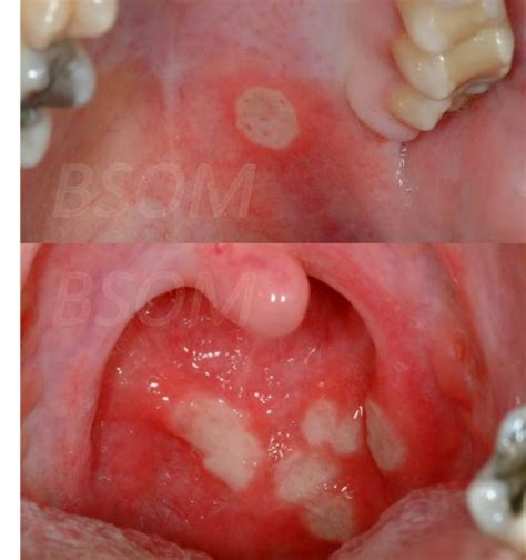 Recurrent Mouth Ulcers Behcets Disease British Cloudyx Girl Pics