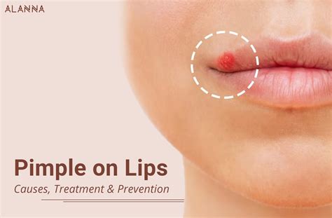 Pimple On Lips Causes Treatment And Prevention Alanna