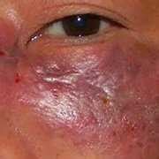 Mucormycosis is a threat to sight and even life but often presents with nonspecific symptoms. News Update! Mark Tatum; the Man Without a Face | Mold ...