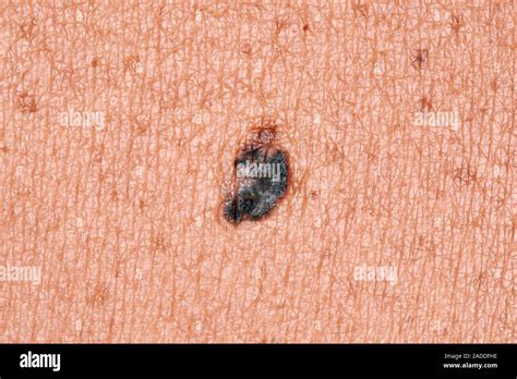 Malignant Melanoma On The Skin Of The Back Of A 52 Year Old Woman