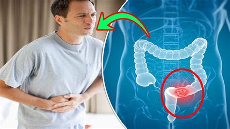 Dont Ignore These 5 Uncommon Signs Of Colon Cancer Youtube