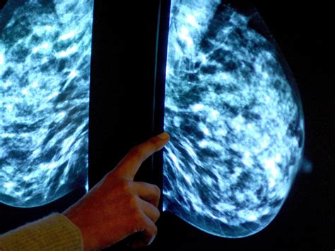 Breast Cancer Test Could Predict Chances Of Diseases Return 20 Years