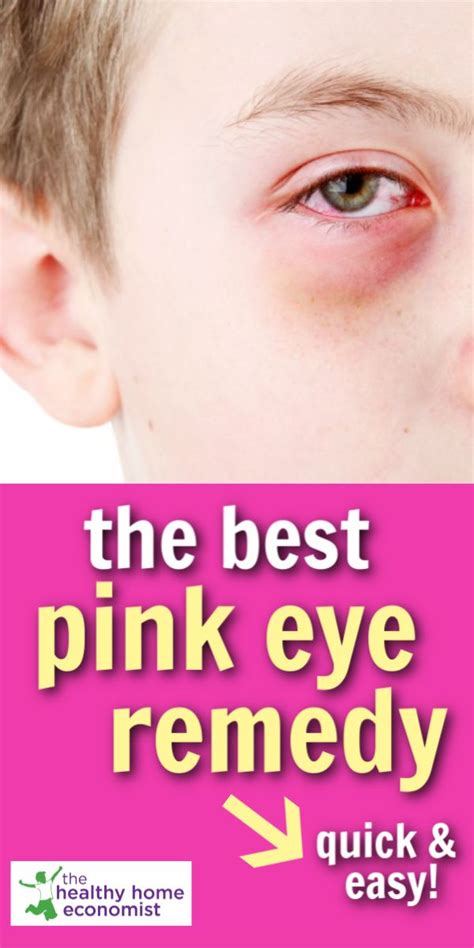 Pinkeye The Fastest And Easiest Home Remedy Pinkeye Remedies Pink