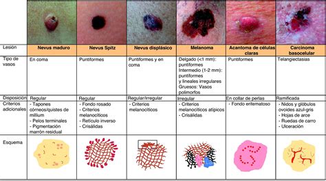 Squamous Cell Carcinoma Medical Science Cancer Skin Quick Study