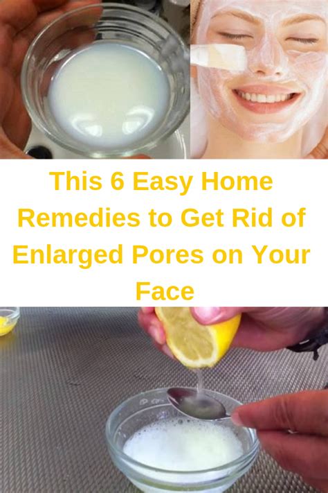 This 6 Easy Home Remedies To Get Rid Of Enlarged Pores On Your Face