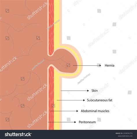 Umbilical Hernia Side View Umbilical Hernia Stock Illustration