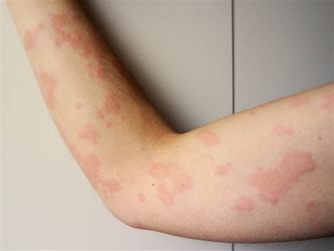 ¿qué Es La Dermatitis Atópica Y Cuáles Son Sus Riesgos N Digital