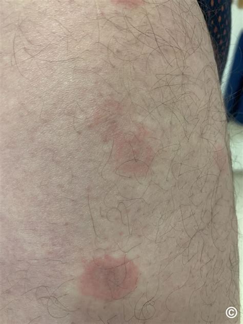 Eosinophilic Annular Erythema