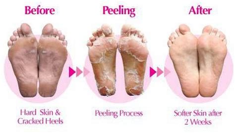 92313 Joyus Foot Peel Dry Skin On Feet Dry Skin Remedies Dry