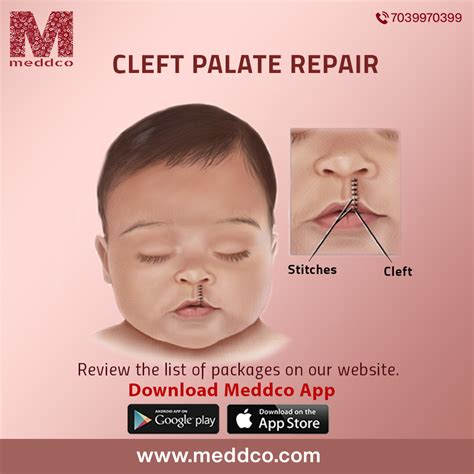 What Is The Treatment For Cleft Palate