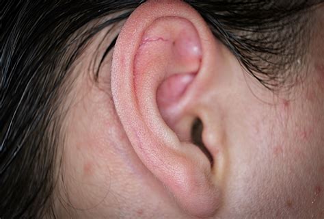 Pimple In Ear How To Prevent And Treat Ear Acne Ph