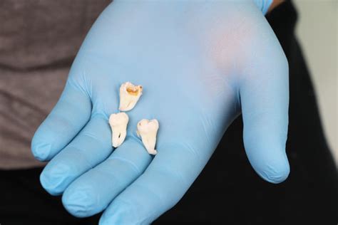 Can Teeth Grow Back After Removal T Tapp