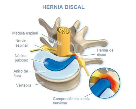 Hernia Discal Cervical ¿hay Que Operarse Advansur Traumatología