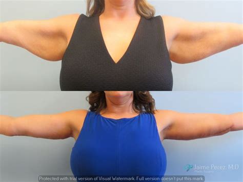Arm Lift After Weight Loss Arm Lift Before And After