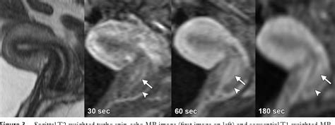 figure 3 from normal or abnormal demystifying uterine and cervical contrast enhancement at