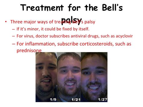 Bell's palsy improves without treatment. Bell'S Palsy