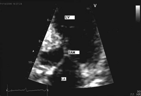 Dynamic Left Ventricular Outflow Tract Obstruction In Acute Myocardial