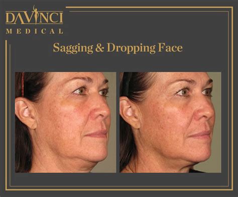 Da Vinci Clinic Facelift Face Contouring Using Ultherapy