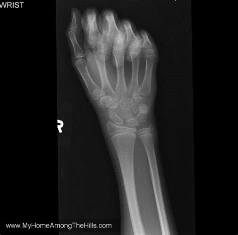 List 98 Images Normal Wrist X Ray Left Hand Completed