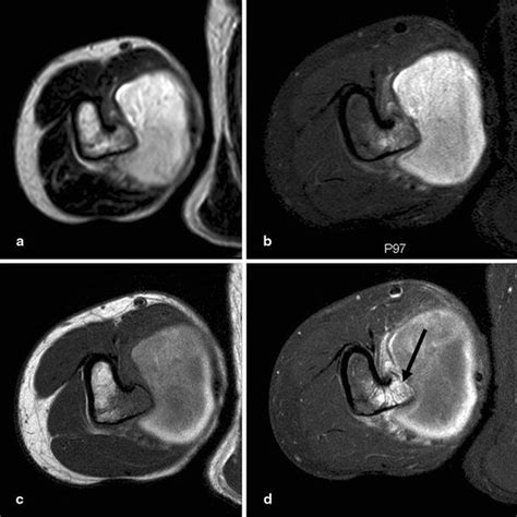 Axial Magnetic Resonance Imaging Mri T A Proton Density Fat Download Scientific Diagram