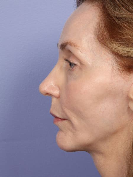 Los Angeles Cheek Chin Shaping Before And After Photos Beverly Hills