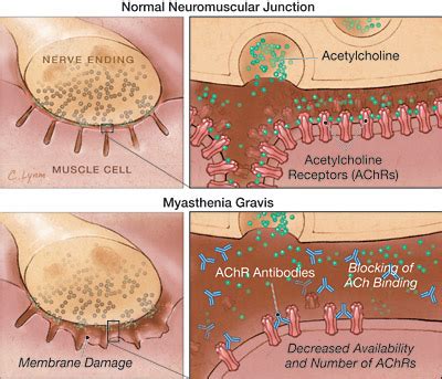 Management of insomnia and anxiety in myasthenia gravis. Myasthenia gravis. Causes, symptoms, treatment Myasthenia ...