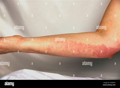 Strong Allergic Rashes On The Arm Impaired Immunity And Reaction To