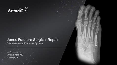 Arthrex Jones Fracture Surgical Repair 5th Metatarsal Fracture System