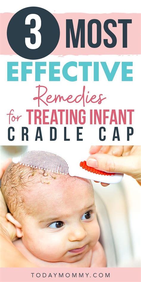 Wondering How To Get Rid Of Cradle Cap Cradle Cap Remedies Baby