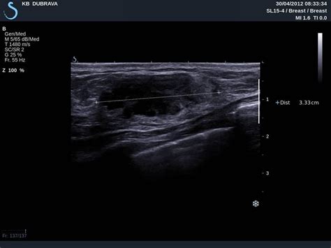 Secondary Breast Lymphoma Ecr 2014 Case Of The Day Eurorad